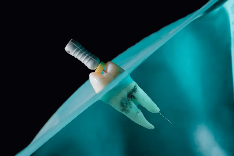 Photo dental tooth extraction procedure