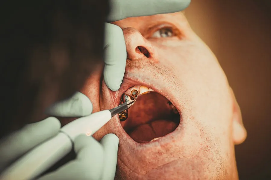 Photo dental fillings information