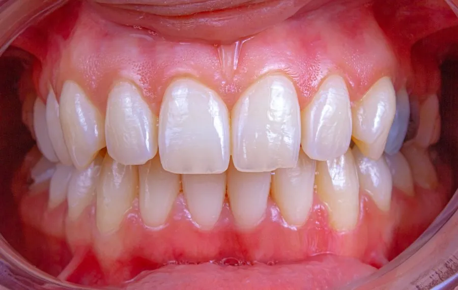 dental tartar removal mistakes