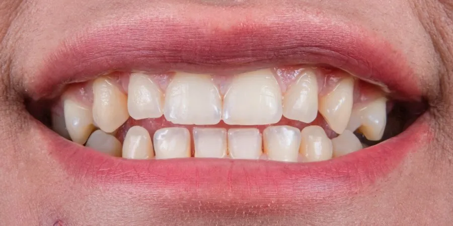 common gingivitis mistakes